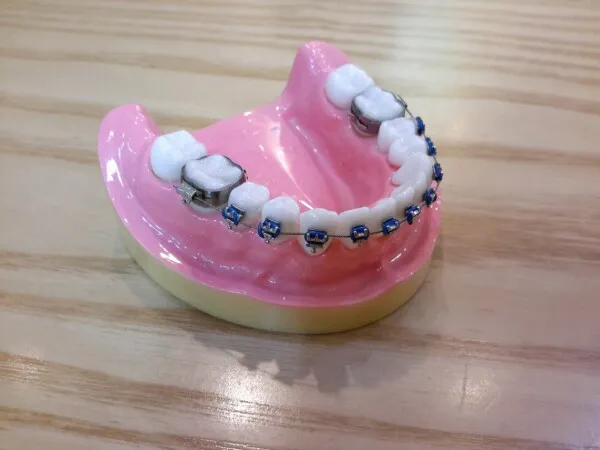 Les Mini vis orthodontiques chez l'adulte Le Perreux sur Marne (94170)   Cabinet d'Implantologie et de Parodontologie du Dr Terence Ammanou Dentiste  au Perreux sur Marne